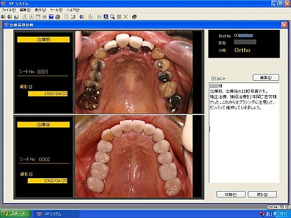歯科インフォームドコンセント用デジタル画像管理ソフト VPシステム 治療前後比較画面